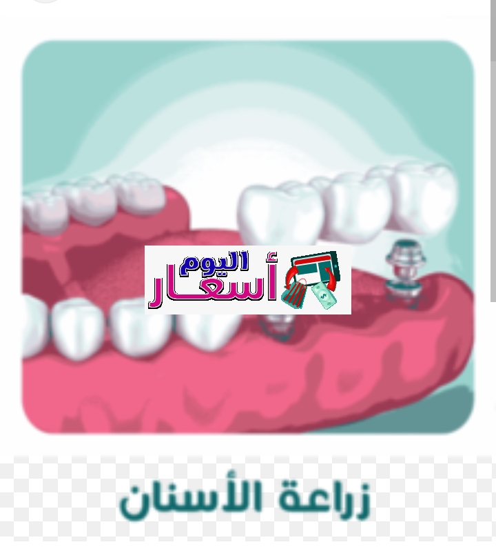 اسعار تركيب الأسنان في السعودية | كم سعر تركيب الزيركون؟