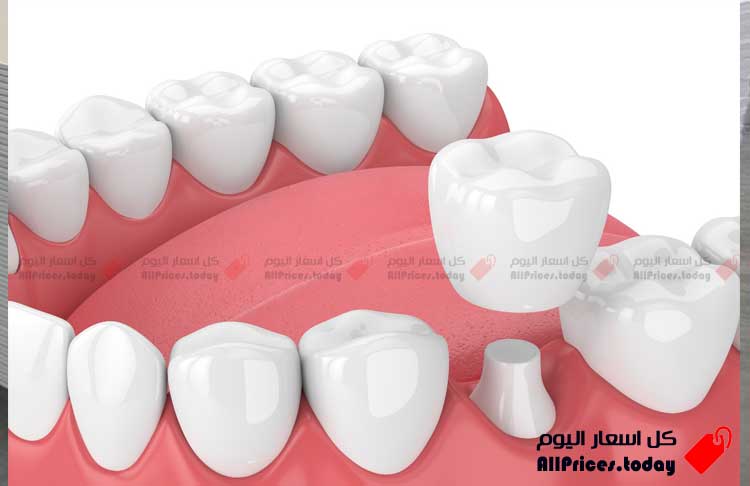 اسعار تلبيس الأسنان في مصر ، تاج أو تلبيس الاسنان الزيركون